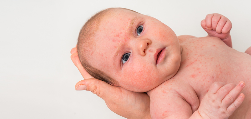 eczema in babies